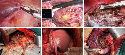 Perioperative and short-term outcomes of laparoscopic liver resection for recurrent hepatocellular carcinoma: A retrospective study comparing open hepatectomy